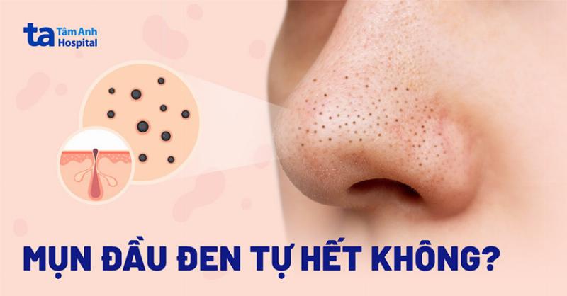 Tạm Biệt Mụn Đầu Đen Ở Mũi: Bí Quyết Trị Tại Nhà Hiệu Quả và An Toàn